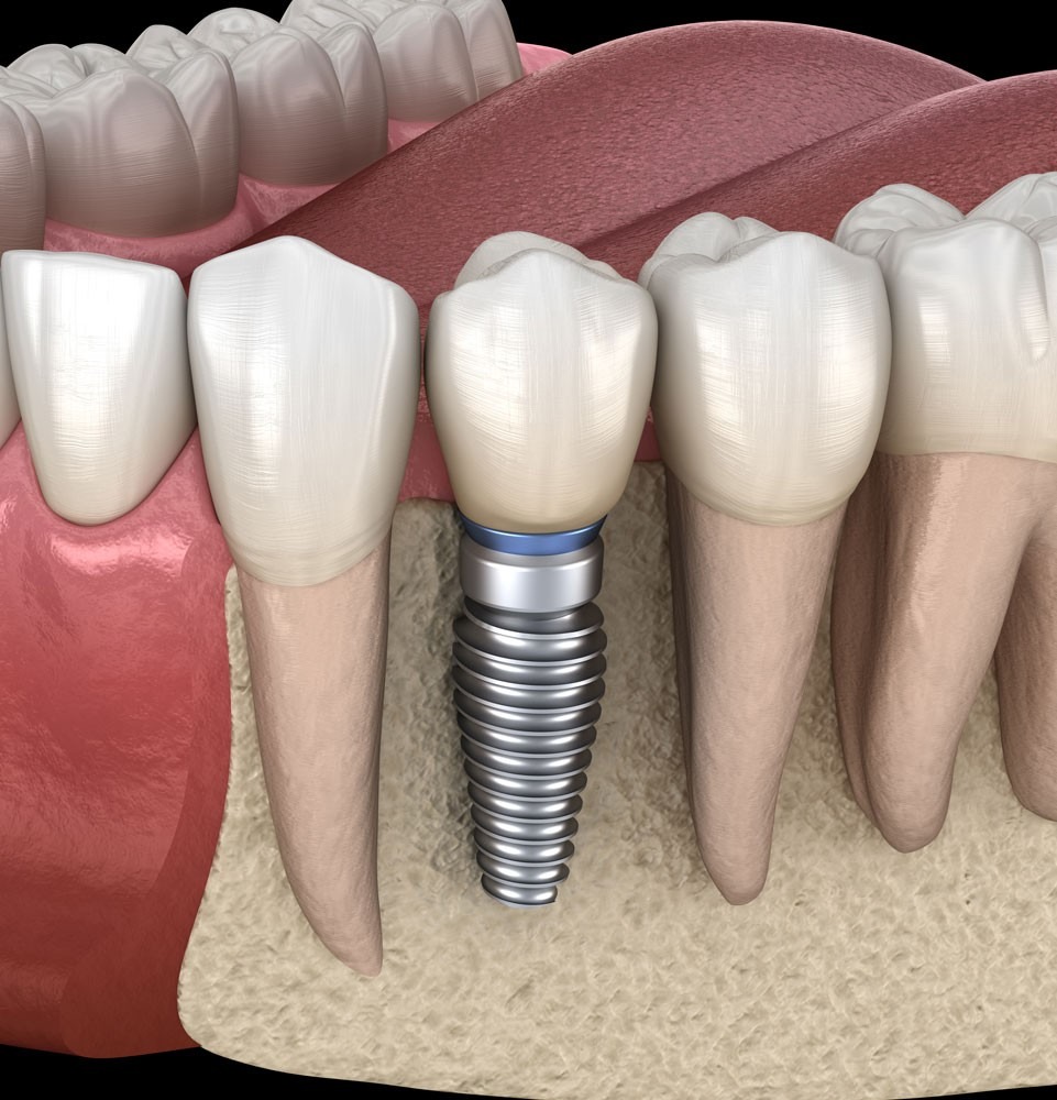 Failing Dental Implants | Implant Dentist Albuquerque, NM